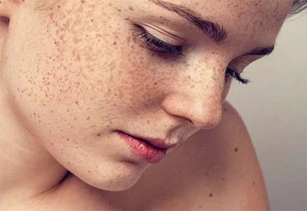 Nhận Biết Tình Trạng Nám Da Từ Sớm Để Giảm Nám Nhanh
