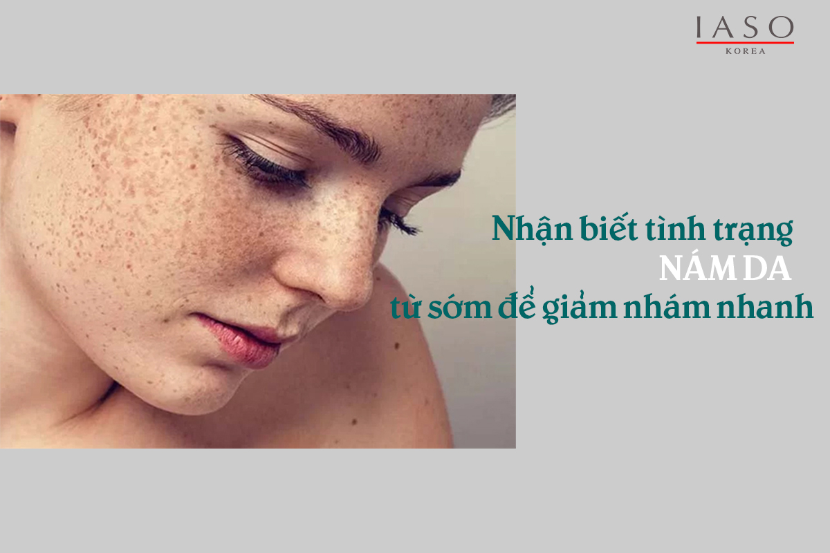 Nhận Biết Tình Trạng Nám Da Từ Sớm Để Giảm Nám Nhanh