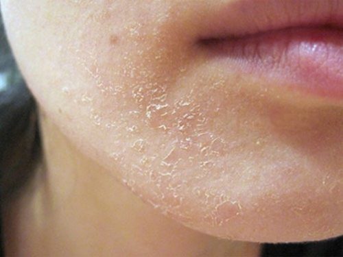 Da Bị Khô Do Thiếu Chất Gì