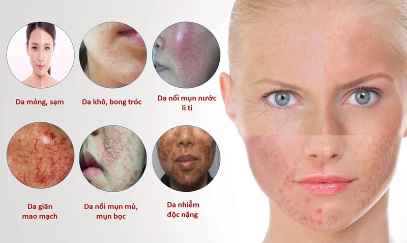 Những tác hại của da bị nhiễm Corticoid