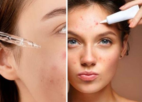 Top Serum Cho Da Dầu Mụn